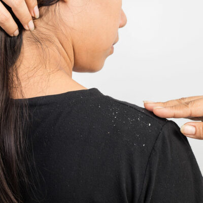 Home Remedies to Banish Dandruff and Flaky Scalp