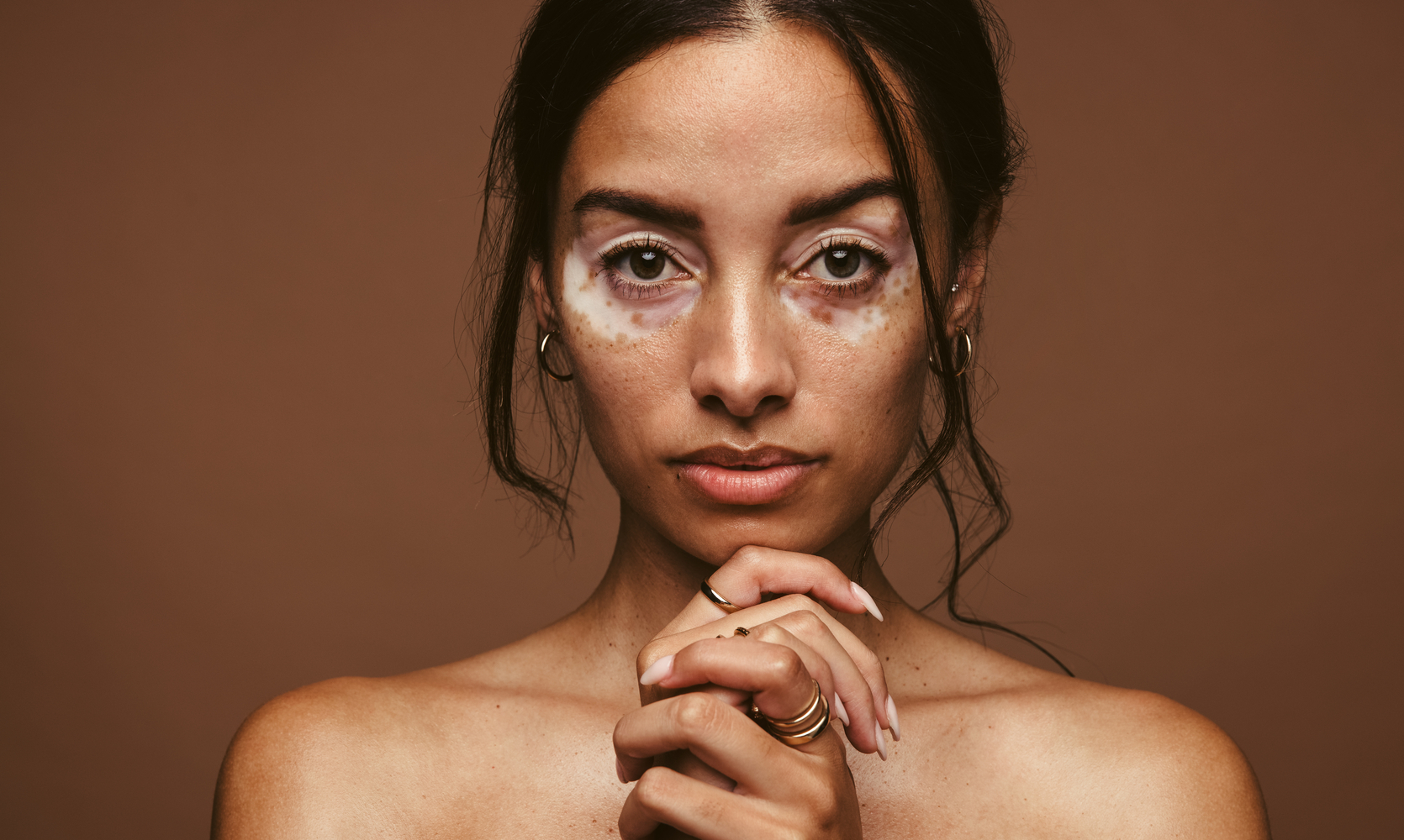 Early Signs of Vitiligo